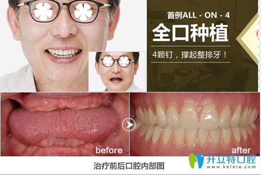深圳格倫菲爾allon4全口種植牙圖