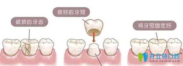 牙冠修復的意義及圖解