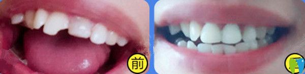 全瓷牙前后對比圖