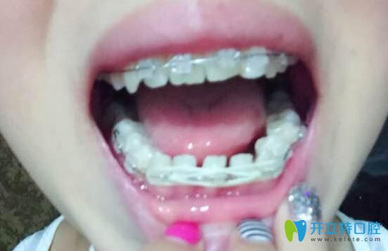 牙根短做矯正效果