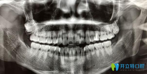 牙根短做正畸5個月自白
