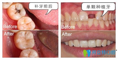 湛江致美口腔種植牙補(bǔ)牙案例