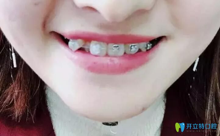 在<!--<i data=20240703-sp></i>-->口腔戴自鎖牙套18天