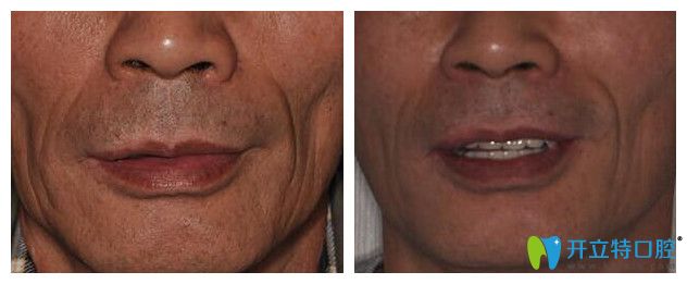 南昌維樂(lè)口腔全口牙種植實(shí)例