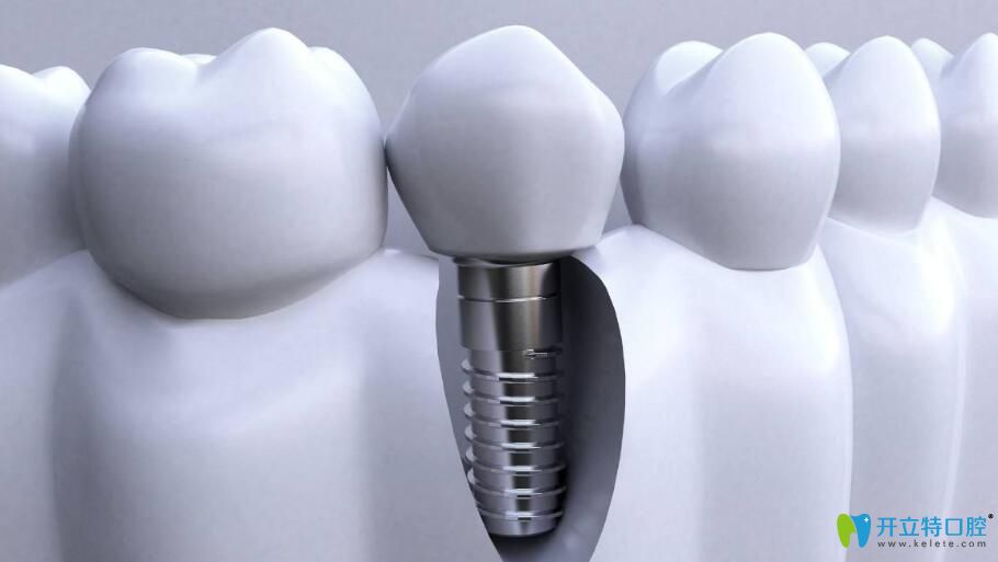 李杰醫(yī)生給大家科普種植牙知識
