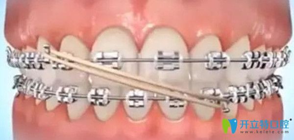 矯正中哪個階段需要佩戴橡皮圈