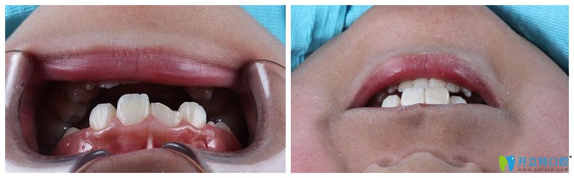 <!--<i data=20240703-sp></i>-->口腔展鵬牙齒修復(fù)案例