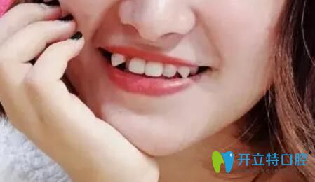 在濟(jì)南品潔口腔矯正虎牙83天，曬我的虎牙戴牙套變化圖