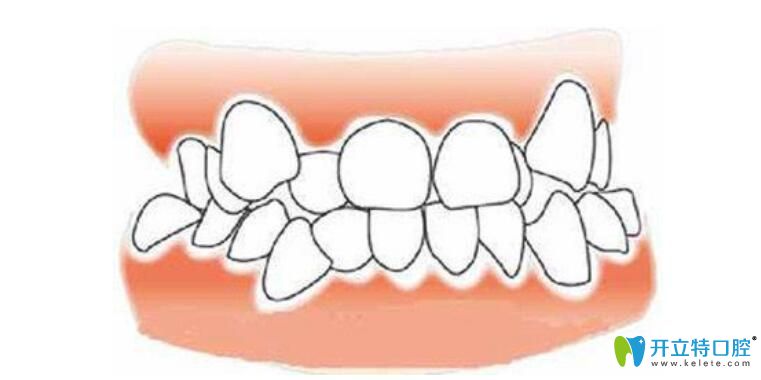 門牙是烤瓷牙矯正方法
