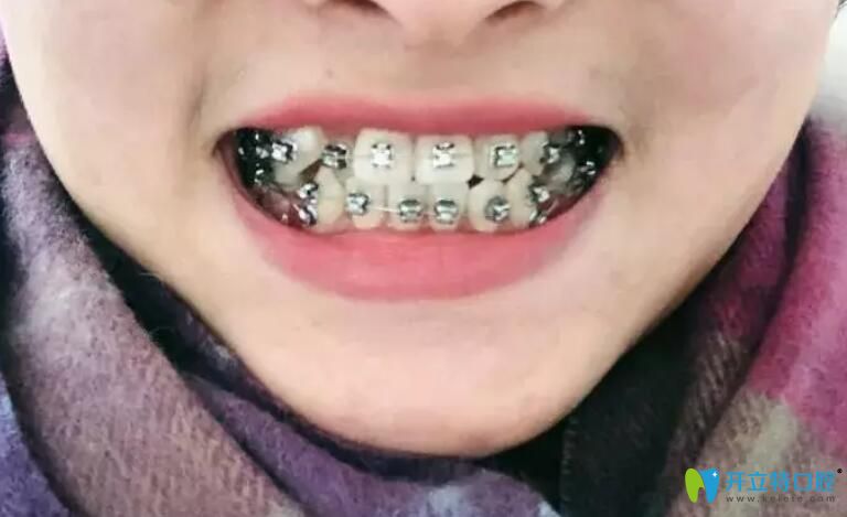 <!--<i data=20240703-sp></i>-->口腔牙矯正83天效果圖