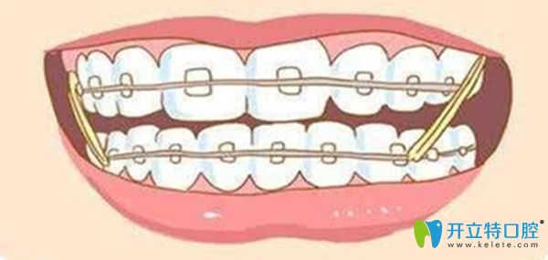 想了解牙齒矯正中橡皮筋的作用/掛多久等等，這里都有哦
