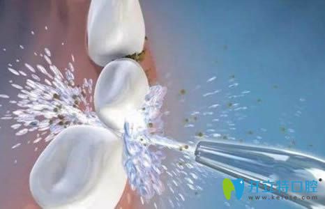 洗牙是否會造成牙隱裂呢