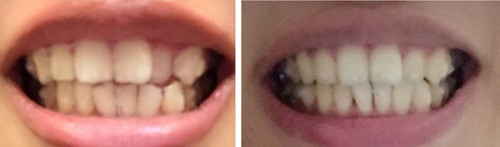 隱適美效果怎么樣?曬在貴陽德韓口腔戴牙套1-12月變化圖