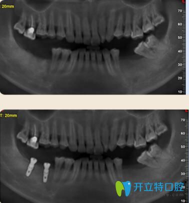 東莞好佰年口腔多顆牙種植案例