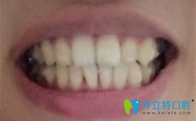 戴隱形牙套6個(gè)月的效果