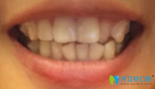 牙齒矯正前的樣子