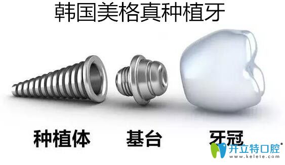 主流種植體:韓國美格真種植牙的優(yōu)缺點(diǎn)及價格