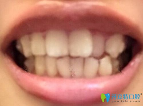 剛開(kāi)始戴第1副隱適美牙套