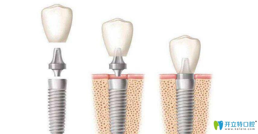 種植牙牙冠能換嗎？種植牙換個牙冠多少錢？