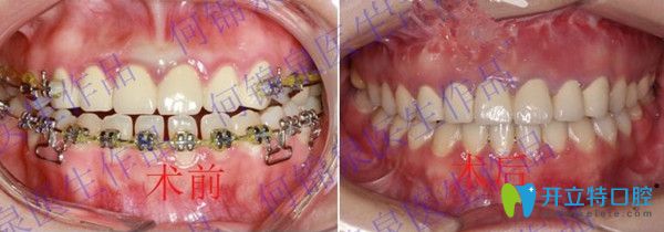 正畸前后效果圖