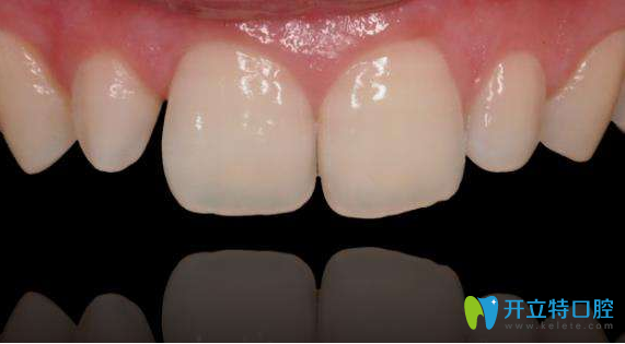 龔歡醫(yī)生解析牙齒仿生美學(xué)修復(fù)價(jià)格需要多少錢