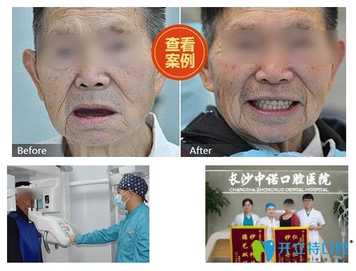 北京中諾口腔60歲老人全口牙種植前后對比效果圖
