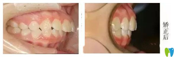 長沙中諾口腔丁建宇深覆蓋牙齒矯正案例
