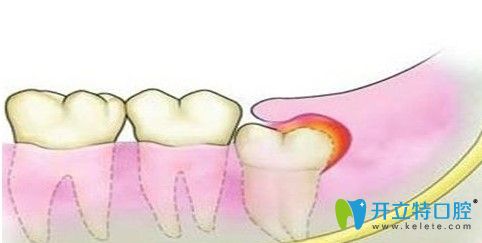 滕艷醫(yī)生解析智齒一定要拔嗎