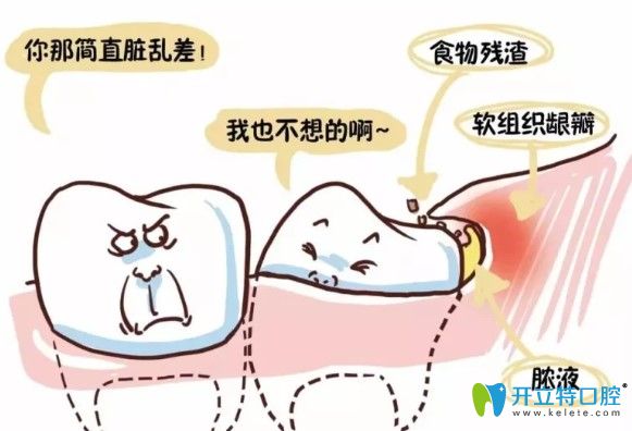 出現(xiàn)這樣的情況智齒就要拔除