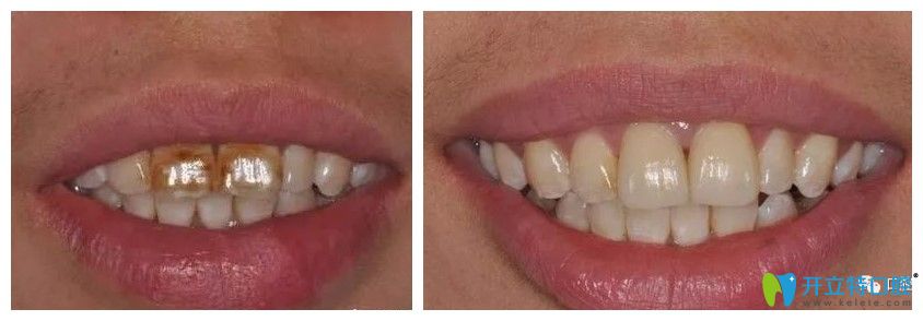 牙齒仿生美學(xué)修復(fù)前后對(duì)比效果圖