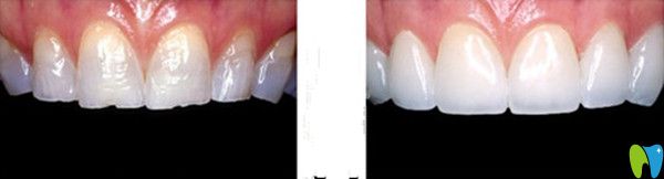 瓷貼面前后對(duì)比圖