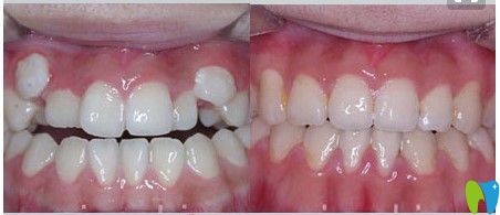 王涪華醫(yī)生成人虎牙矯正前后對比案例圖