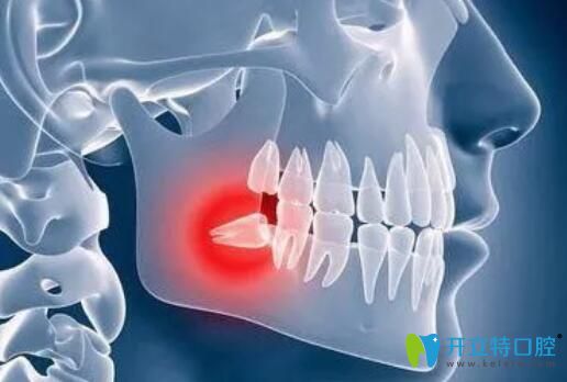 求解：我拔一顆智齒花了500多塊錢是不是被坑了？