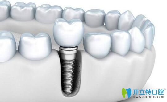 劉安賞告訴大家：種植牙的價(jià)格主要受什么影響