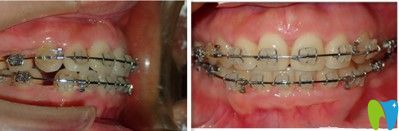 戴半隱形陶瓷牙套中的照片