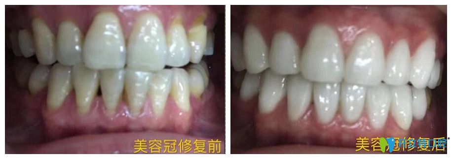 逸盛口腔真人案例驗(yàn)證好不好