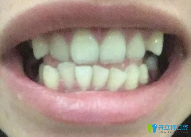 牙齒擁擠不齊選擇在杭州逸盛口腔做了正畸,歷時(shí)733天下牙套