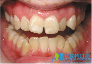 參考過長(zhǎng)沙牙齒矯正醫(yī)院排名后去中諾口腔做了對(duì)刃頜矯正