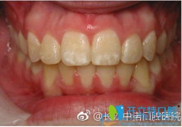 在長沙中諾口腔做對刃頜矯正一年多后效果圖