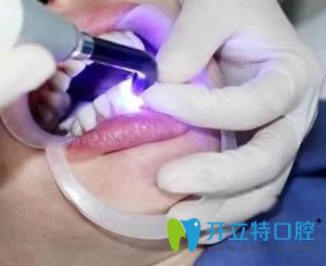 衡陽(yáng)美萊口腔做全瓷牙貼面術(shù)中照 衡陽(yáng)美萊口腔做全瓷牙貼面術(shù)中照