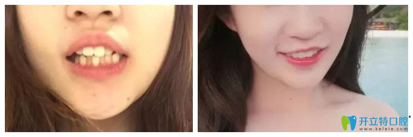 案例來驗(yàn)證泗洪眾迪口腔王菲菲牙齒矯正怎么樣