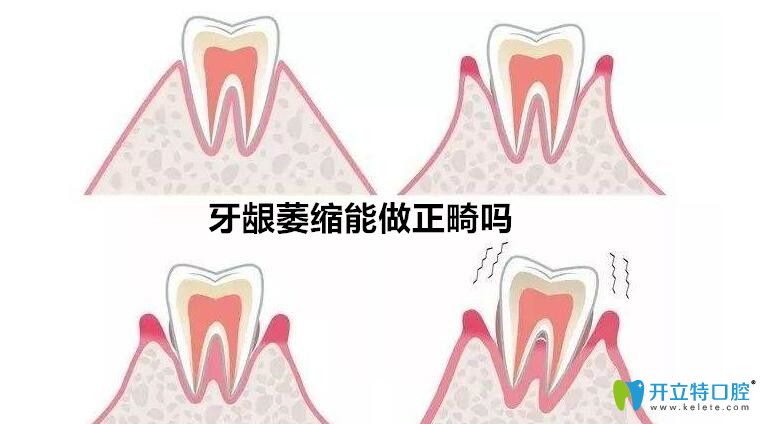 牙齦萎縮能矯正牙么？聽泗洪口腔正畸醫(yī)生解說