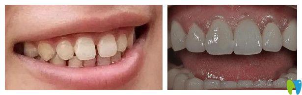 合肥崔勁松口腔崔瑩瑩醫(yī)生牙齒貼面案例