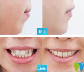 衡陽(yáng)美萊口腔黃安醫(yī)生牙齒矯正效果對(duì)比圖