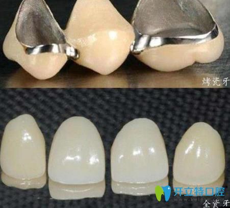 李遷醫(yī)生科普：烤瓷牙和全瓷牙的區(qū)別是什么，哪個(gè)好？