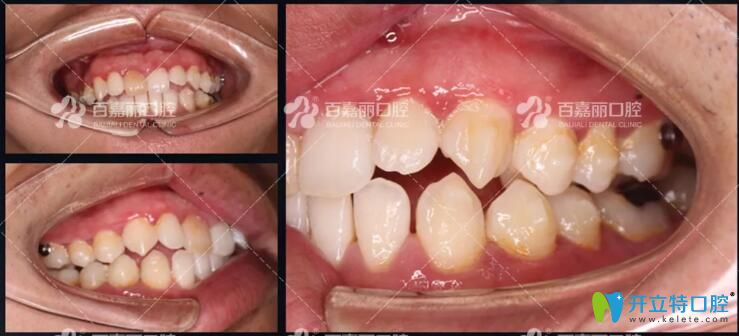 百嘉麗口腔隱適美隱形矯正反頜效果圖