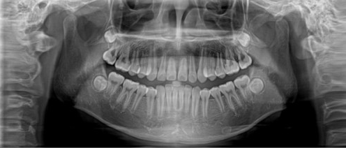 牙齒矯正前的CT/全景片檢查有必要做嗎？