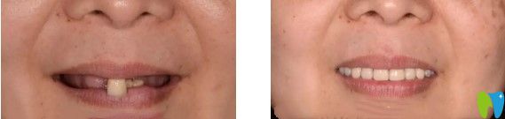 天津市中諾口腔全口即刻種植牙對(duì)比效果