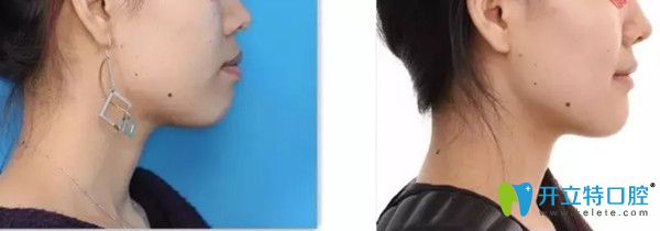 鄭州哪家正畸好?看完拜博口腔矯正案例及價格再做決定