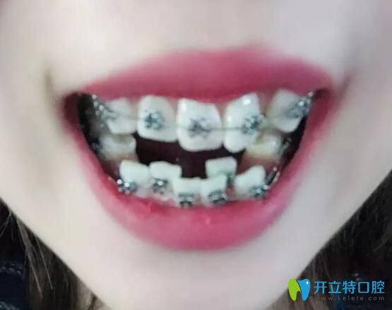 我在合肥崔勁松口腔做金屬托槽矯正13個(gè)月,牙齒擁擠沒(méi)有啦!